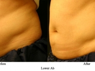 lower-ab-7-a