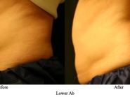 lower-ab-7-b