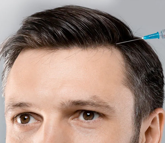 PRP treatments for hair