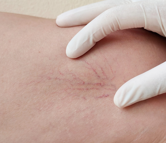 Portrait showing the hand holding the skin and varicose veins on the leg